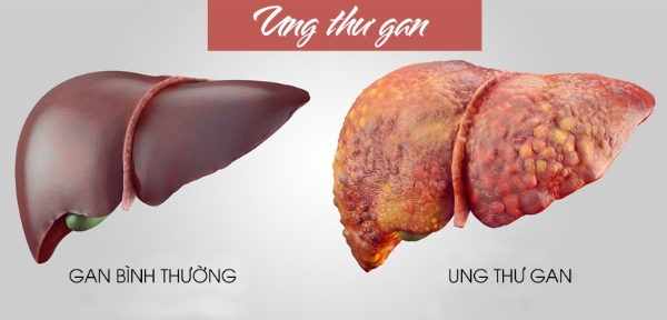 Cô gái 29 tuổi qua đời vì ung thư, bác sĩ chỉ ra thói quen sai lầm ít ai biết - Ảnh 2